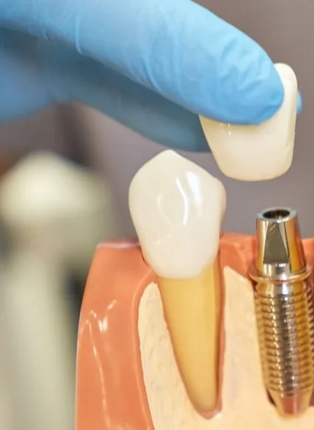 Dental Implants